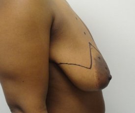 Manhattan Breast Reduction before 1